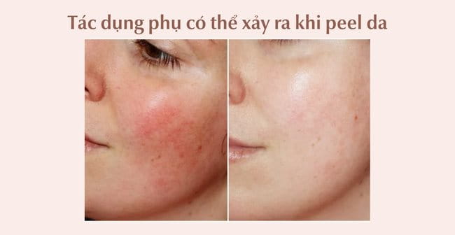 Peel Da Là Gì? Có Tốt Không? Quy Trình Peel Da Chuẩn Y Khoa A-Z