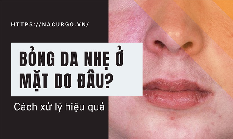 Bỏng da nhẹ ở mặt do đâu? Mách cách xử lý hiệu quả