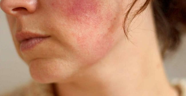 Da mặt bị đỏ (Rosacea): Nguyên nhân, biểu hiện, cách điều trị