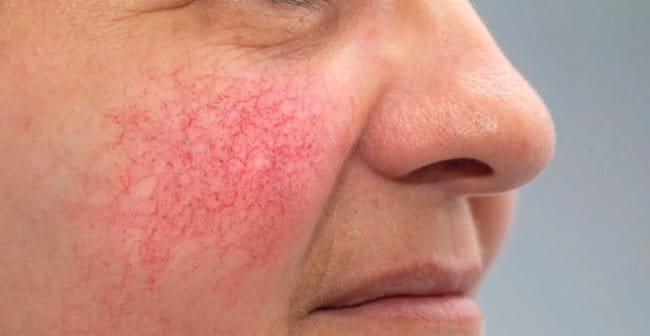 Da mặt bị đỏ (Rosacea): Nguyên nhân, biểu hiện, cách điều trị