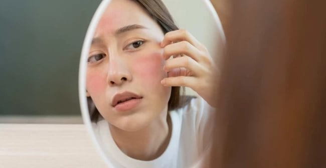 Da mặt bị đỏ (Rosacea): Nguyên nhân, biểu hiện, cách điều trị