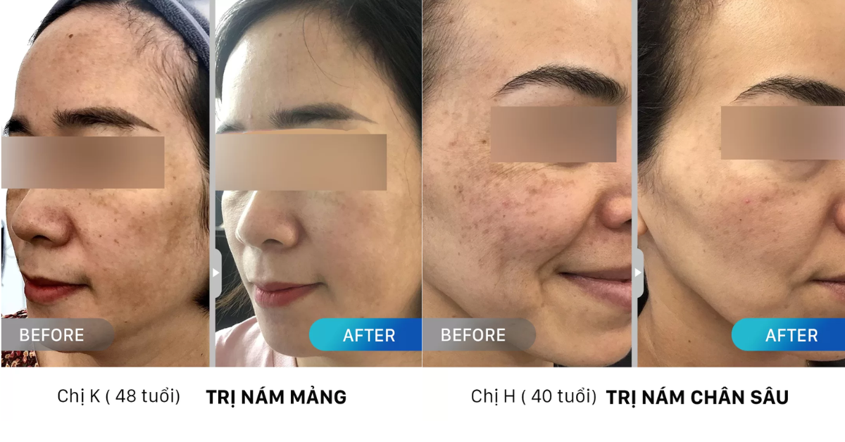 Trị nám bằng laser bao nhiêu tiền? Bảng giá tại 6 địa chỉ uy tín TPHCM