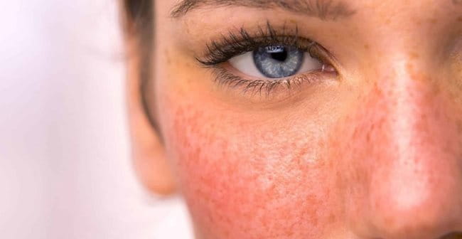 Da mặt bị đỏ (Rosacea): Nguyên nhân, biểu hiện, cách điều trị