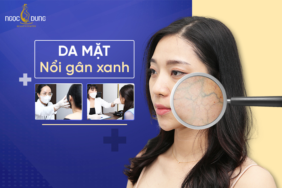 Nguyên nhân da mặt nổi gân xanh và 7 cách điều trị hiệu quả