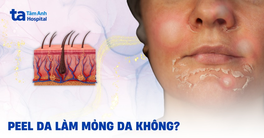 Peel da có làm mỏng da không? Tần suất bao nhiêu là phù hợp?