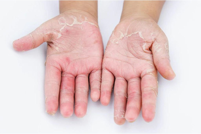 Bệnh nấm da tay: Nguyên nhân, triệu chứng và cách điều trị
