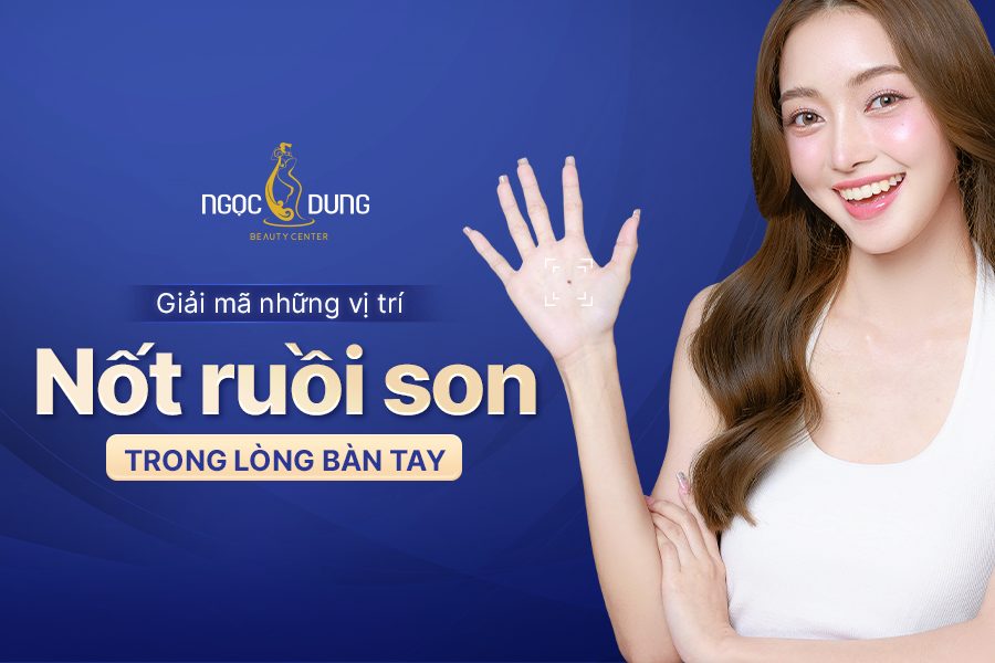 Giải mã nốt ruồi son trong lòng bàn tay: Tốt hay xấu?