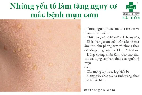 Mụn cơm, dấu hiệu nhận biết và cách điều trị