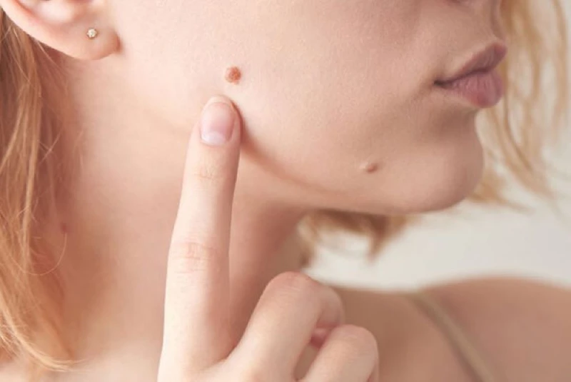Tẩy nốt ruồi bao nhiêu tiền? Cách chăm sóc da chuẩn y khoa sau khi tẩy nốt ruồi