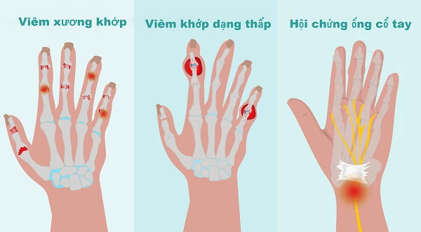 Đau khớp ngón tay: Nguyên nhân do đâu? - Bệnh viện Đa khoa Vạn Hạnh