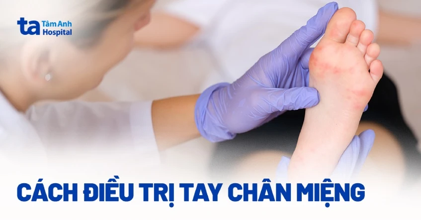 Cách điều trị tay chân miệng đúng cách nhanh khỏi