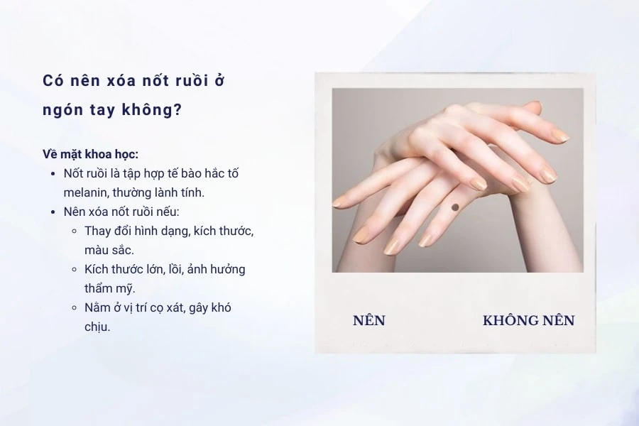 Nam, nữ có nốt ruồi ở ngón tay tốt hay xấu? Có nên xóa không?