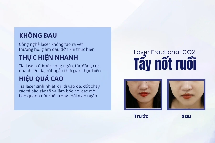 Nam, nữ có nốt ruồi ở ngón tay tốt hay xấu? Có nên xóa không?