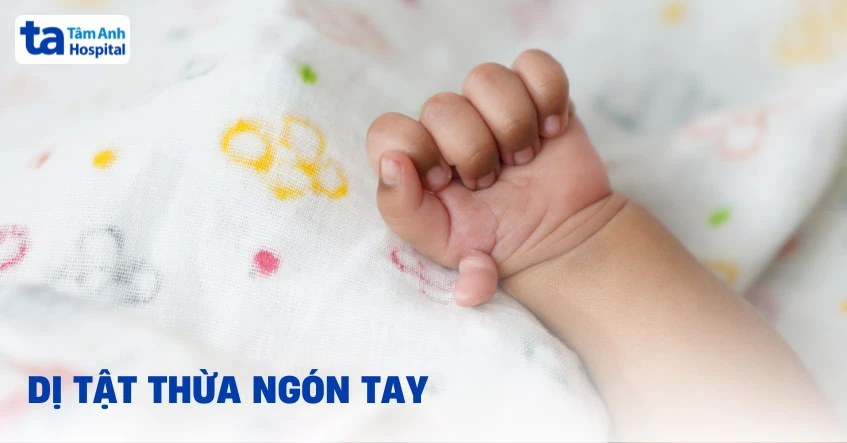 Dị tật thừa ngón tay: Nguyên nhân, dấu hiệu, chẩn đoán và điều trị