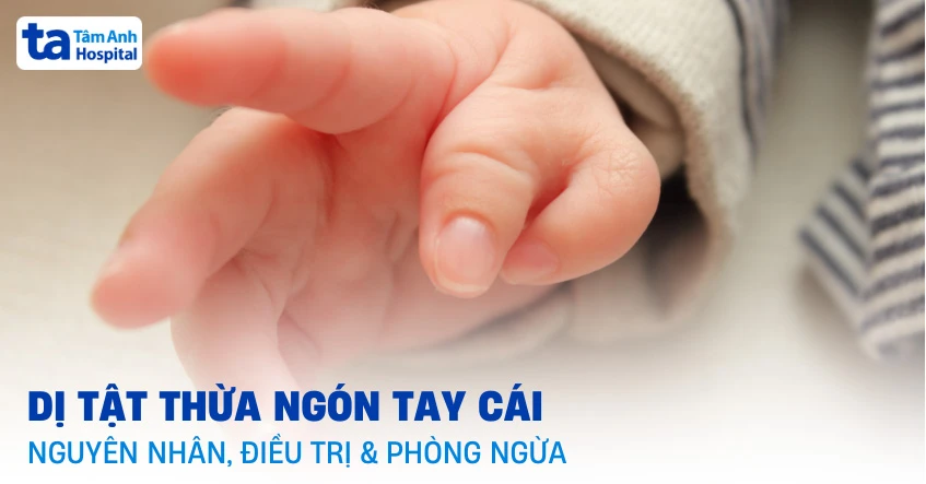 Dị tật thừa ngón tay cái: Nguyên nhân, dấu hiệu và cách điều trị