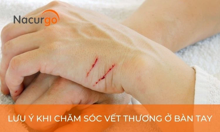 Xử lý vết thương ở bàn tay như thế nào?