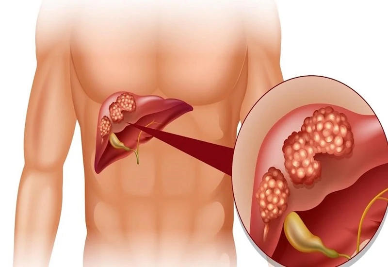 Bác sĩ giải đáp thắc mắc: Bàn tay son có phải dấu hiệu của bệnh gan?