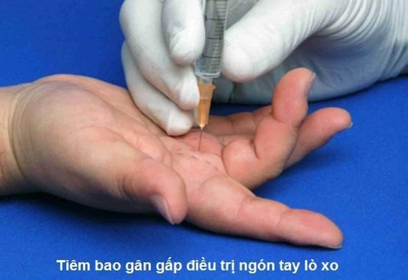 Ngón tay lò xo: Triệu chứng và phương pháp điều trị bệnh