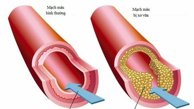 Đo huyết áp tay nào và cách đo đúng tại nhà