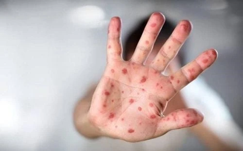 Trẻ bị tay chân miệng bao lâu thì khỏi và cách chăm sóc