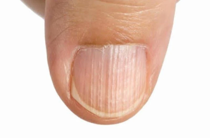 Cách Nhận Diện Móng Tay Có Sọc Nâu Mờ Đơn Giản