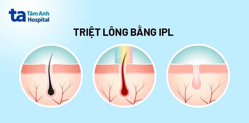 Triệt lông chân vĩnh viễn là gì? 4 cách được ưa chuộng hiện nay