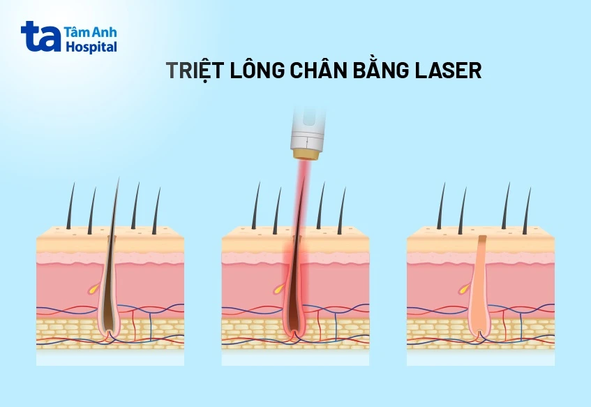 Triệt lông chân vĩnh viễn là gì? 4 cách được ưa chuộng hiện nay