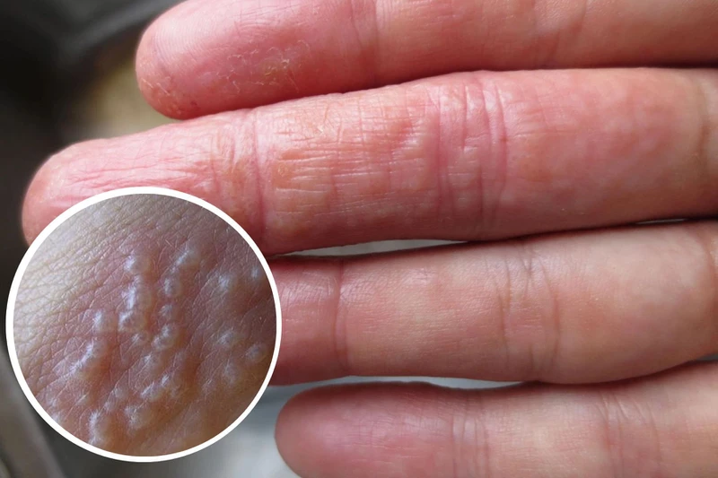 Nguyên nhân và cách điều trị tay nổi mụn cứng