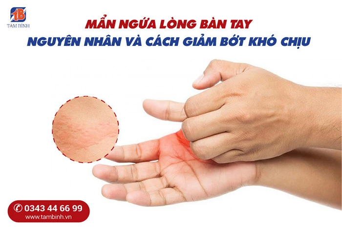 Mẩn ngứa lòng bàn tay - Nguyên nhân và giải pháp điều trị