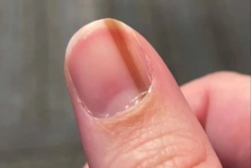 Giải đáp: Ung thư hắc tố móng tay sống được bao lâu?