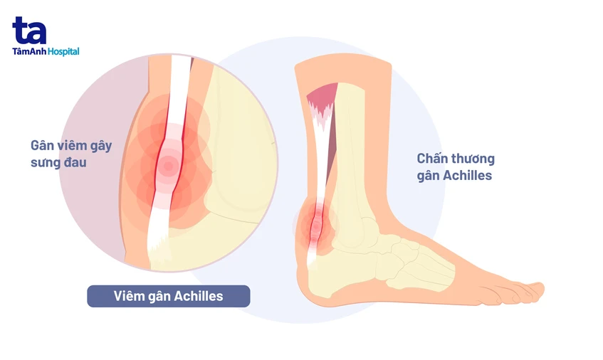 Viêm gân: Nguyên nhân, dấu hiệu, điều trị, phòng ngừa