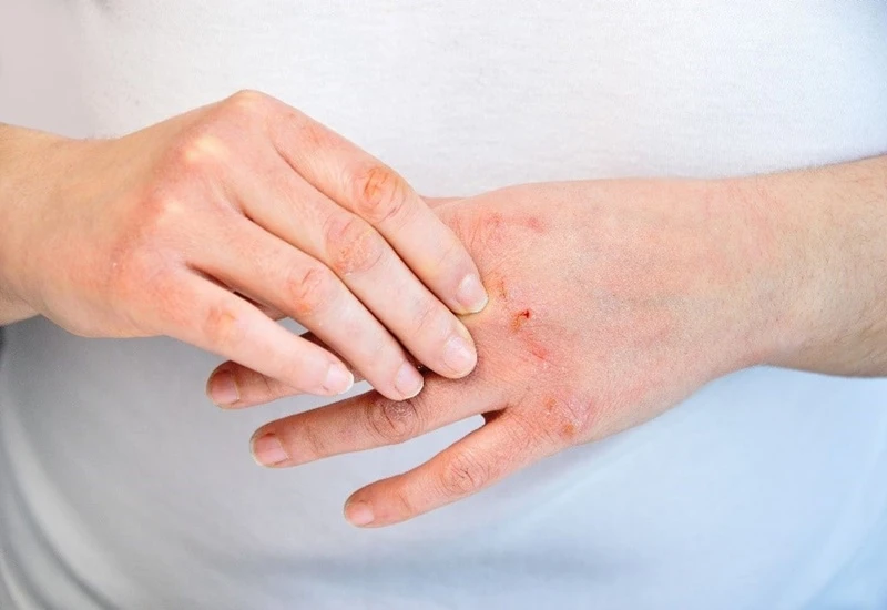 Nguyên nhân da tay bị khô và cách khắc phục hiệu quả