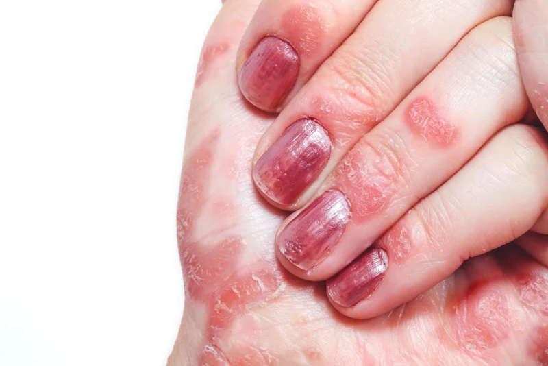 Ngứa đầu ngón tay ngón chân: Nguyên nhân và cách chữa trị