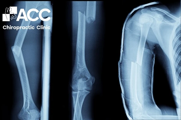 Đau cơ bắp tay có sao không? Nguyên nhân & cách điều trị hiệu quả
