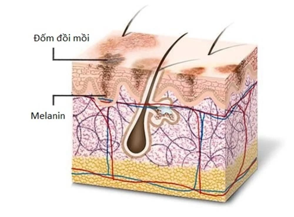 Vì sao xuất hiện đồi mồi trên da? Làm thế nào để cải thiện?