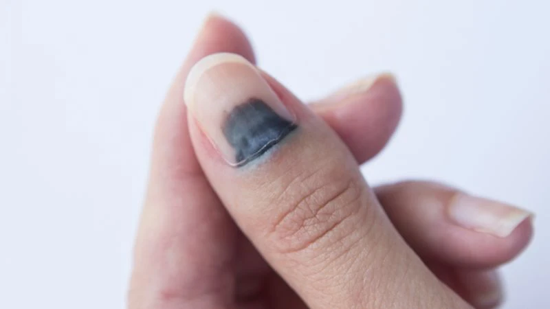 Nguyên nhân móng tay bị tím và cách khắc phục