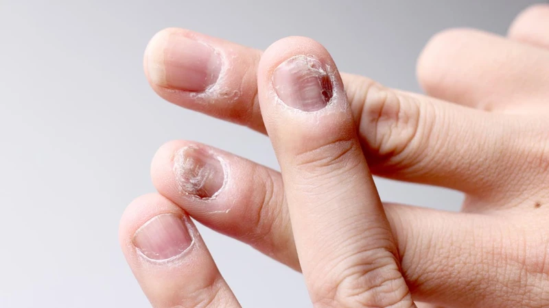 Nhìn móng tay đoán bệnh, bạn đã biết chưa?