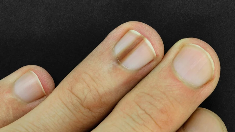 Nhìn móng tay đoán bệnh, bạn đã biết chưa?