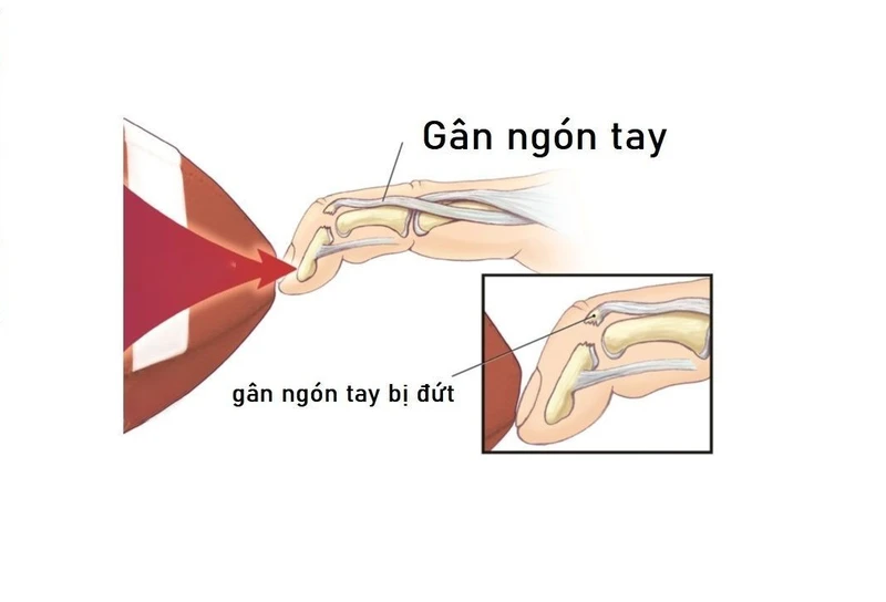 Bị đứt gân ngón tay bao lâu thì khỏi?