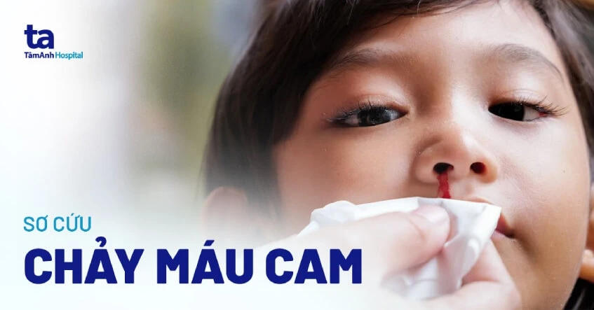 Cách sơ cứu chảy máu cam (mũi) nhanh chóng, hiệu quả, an toàn